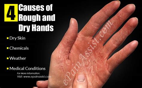 4 Causes Of Rough And Dry Hands And Its 6 Home Remedies