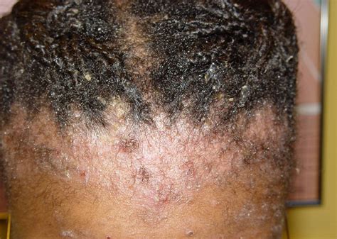 It's More Than Just Dandruff - MDhairmixtress.com