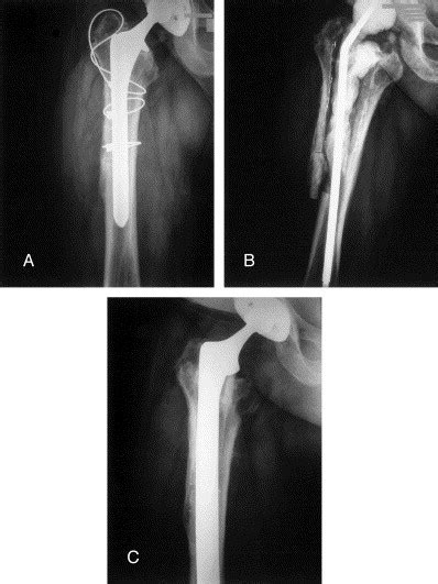 Extended Trochanteric Osteotomy For 2 Stage Revision Of Infected Total