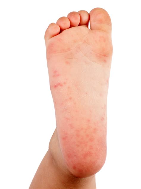 Its Not Strep Throat Treating Hand Foot And Mouth Disease