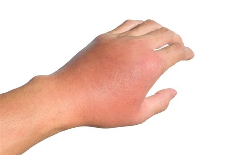 Inflamación hinchazón enrojecimiento de la mano que muestra infección
