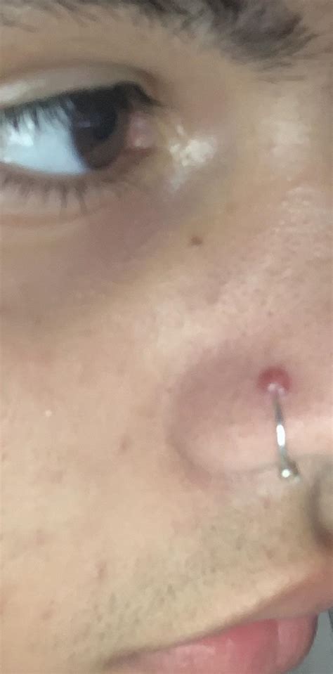 anyone know how to treat this or what it is i got my nose pierced about 4 months ago and i