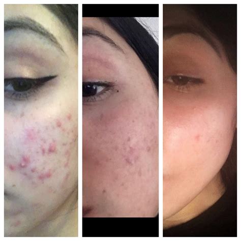 Beforeandafter After Having Acne For 7 Years I Finally Can Say Im