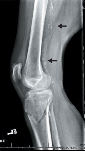 Proximal Tibial Fractures Musculoskeletal Key