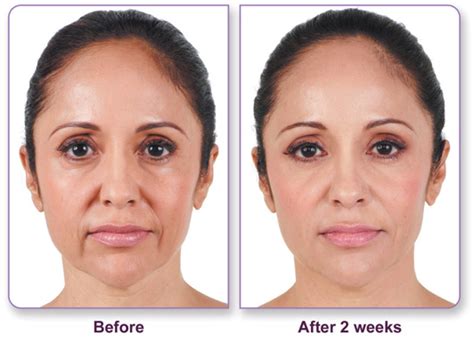 About our skin care professionals. Juvederm Facial Filler Before & After