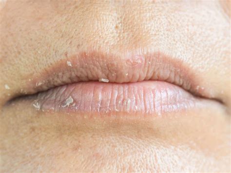 Lip Eczema Treatment
