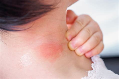 Red Spots On Neck Itchy Lesion Heralds Pervasive Problem