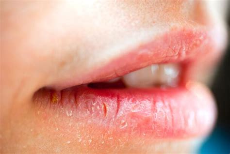 Cracked Lips Symptoms Causes Treatments