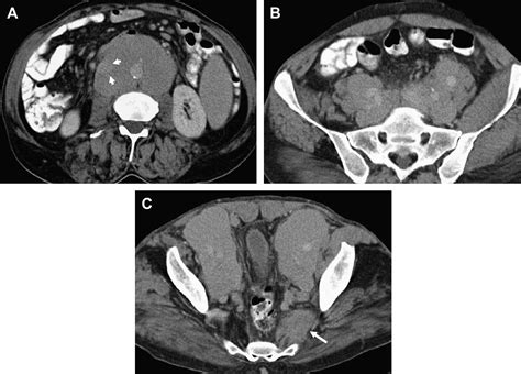 Imaging Of Abdominal Lymphoma Radiologic Clinics