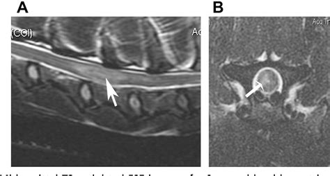 Figure 1 From Fibrocartilaginous Embolic Myelopathy In Small Animals