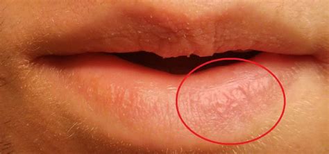 Permanent Peelingdry Spot On Lip At Peeling Lips Exfoliative Cheilitis