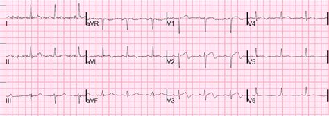 De winter sign on ecg is detected in 2% of patients with critical stenosis or occlusion of the left anterior descending artery. De Winter and Wellen T waves - Electrocardiology Instruction