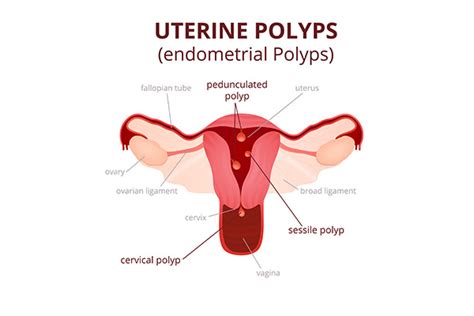 Polyps Judy Wong Clinic For Women