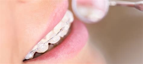 Damon Clear Braces Putney Expert Dental Practice Wandsworth