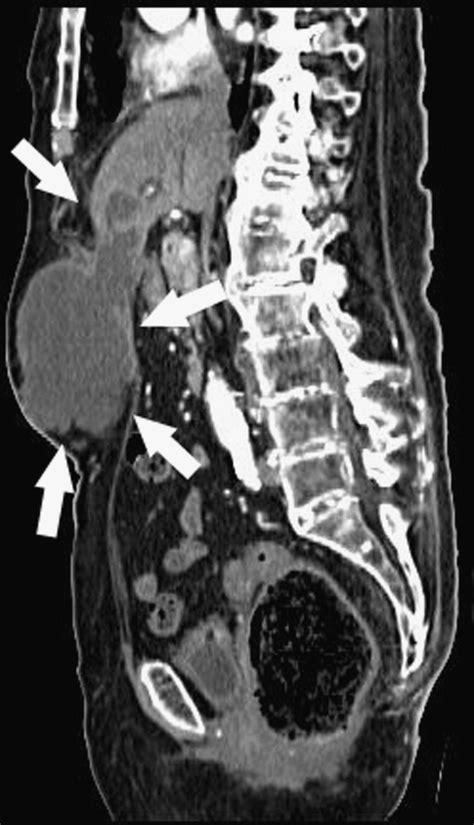 Axial Abdomen Ct Scan Shows Trans Fascial Abscess Resulting From