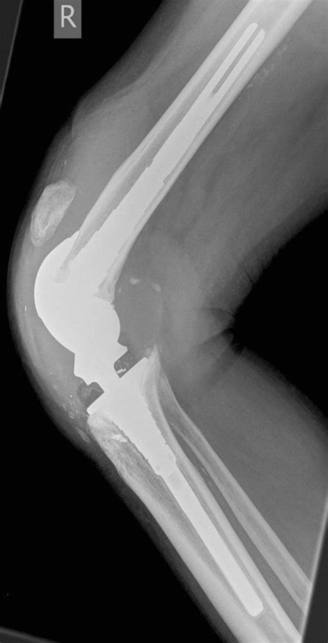 Lateral Knee Radiograph Demonstrating Extensor Mechanism Failure With