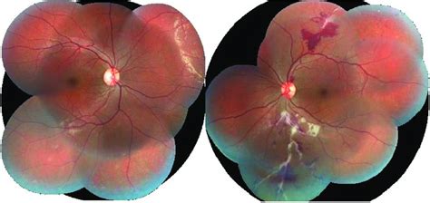 Fundus Photo Montage Showing Normal Right And Left Eye Showing