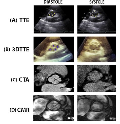 Quadricuspid Aortic Valve On A Transthoracic Echocardiography Tte