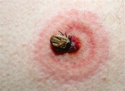 Plus de 50 % des patients ayant eu un erytheme migrant non traité feront de l'arthrite (genoux++), environ 10 % auront une maladie neurologique. Maladie de Lyme : symptômes à surveiller après une piqûre ...
