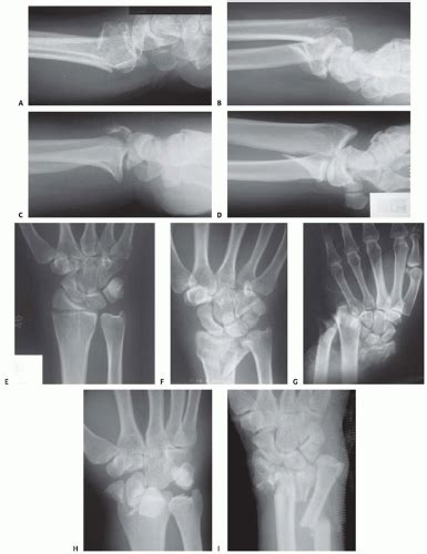Fragment Specific Fixation Of Distal Radius Fractures Musculoskeletal Key