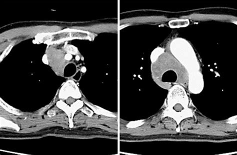 Chest Contrast Enhanced Ct Showed Mediastinal Tumor With Lymph Node