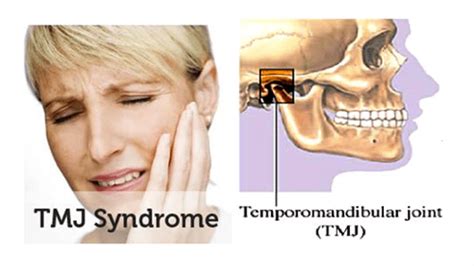 Temporomandibular Joint TMJ Disorder Orange County Huntington Beach