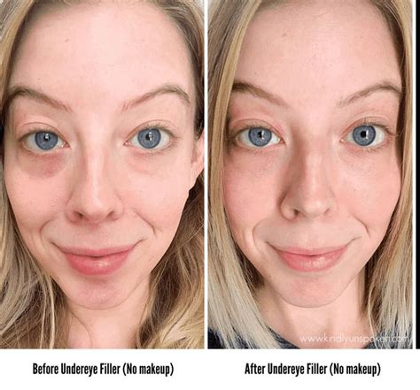 Under Eye Fillers For Dark Circles Before And After Under Eye Fillers