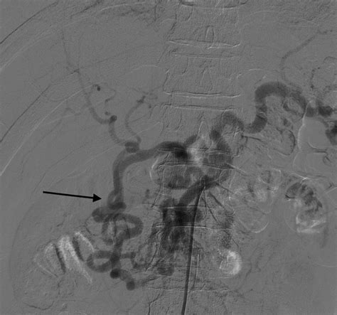 Transsplenic Arterial Radioembolization Of Hepatic Metastases In A