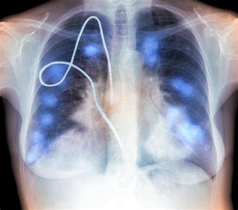 secondary lung cancers x ray photograph by du cane medical imaging ltd fine art america