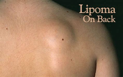 Lipoma Dissolving Essential Oils Get Rid Of Fatty Tumors Without