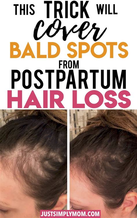 Is postpartum hair loss normal? How to Quickly Cover Bald Spots During Postpartum Hair ...