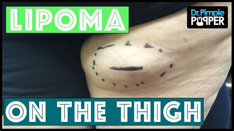 A Lipoma Excised From The Right Posterior Thigh On A Popaholics Mom