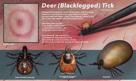Illustration Showing A Deer Tick Bite And Its Removal Stocktrek Images