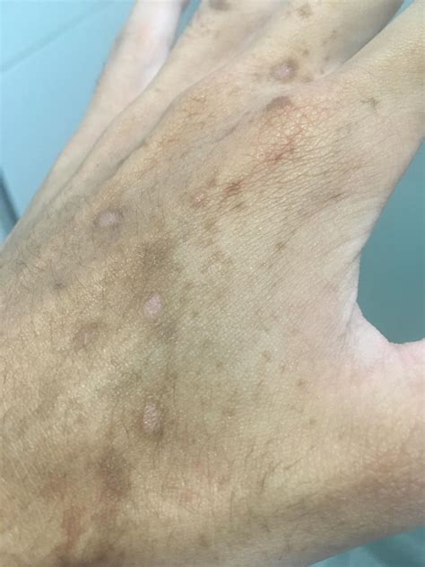 M20 Brown Spots Appeared Only On My Left Hand Overnight Then White