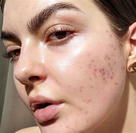 Pin By Anna Stevenson X On Acne Facial Skin Care Routine Pretty