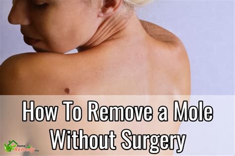 How To Remove A Mole Without Surgery Home Remedies