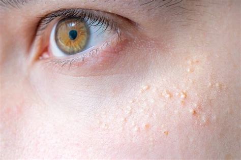 Lumpy Skin Disease Stock Photos Pictures And Royalty Free Images Istock