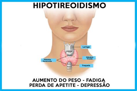 Hipotireoidismo Causas Sintomas Tratamento Tem Cura Engorda