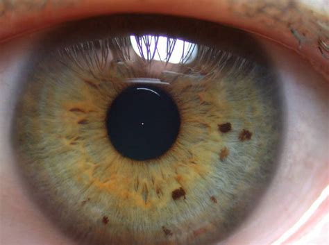Due to an uneven distribution of melanin, the outer ring will almost always be blue or green. Modern & Multidimensional Iridology: Dyscratic Diathesis ...