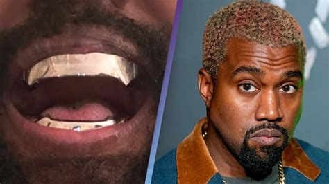 Kanye Wests Unique 850000 Titanium Dentures Are Permanent And Go