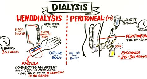 How Hemodialysis And Peritoneal Dialysis Work United Dialysis Center