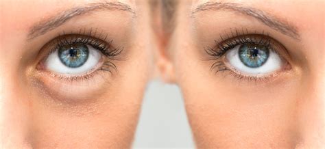 Puffy Eyes. How To Treat Them With Natural Remedies | STD ...