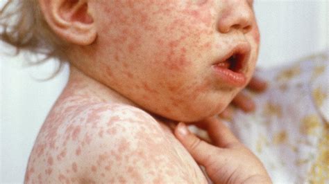 Measles Wreaks Havoc On Bodys Immune System Making It Susceptible To