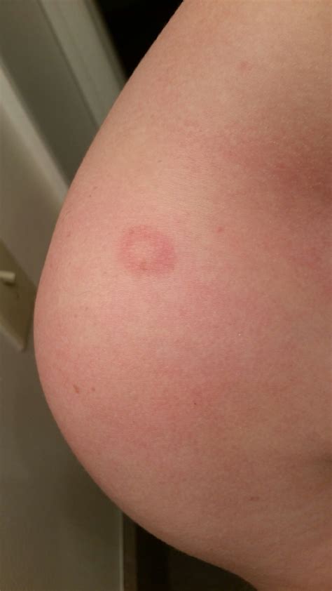 Odd Ring Looking Rash On My Shoulder Painful Infect Skin Doctor