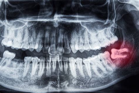 Impacted Wisdom Tooth Everything You Should Know And Do 2022