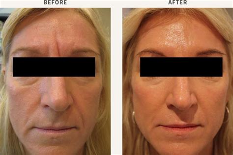 Dermal Fillers Sydney Chatswood And Sutherland Shire Sydney