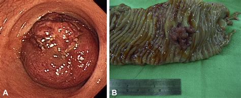 The colon is a part of the large intestine. Sigmoid colon cancer with intussusception reduced by colonoscopy - Gastrointestinal Endoscopy