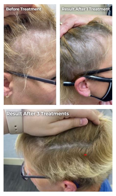 Hair Loss Treatments For Women In Cincinnati Ohio