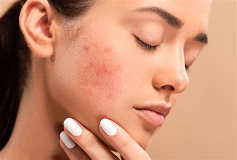 Scabs On Face Common Reasons And Ways To Manage Them