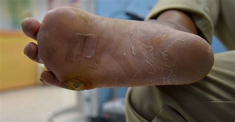 Learn About The Cause And Prevention Of Diabetic Foot Ulcers Wcei Blog
